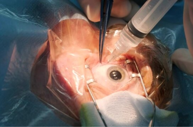 Vitreoretinal Surgeries
